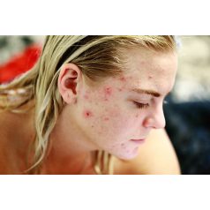 Rosacea, pattanás, bőrgyulladás